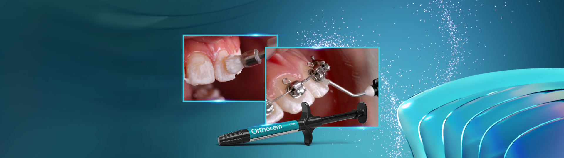 Complementary adhesive devices for orthodontic treatment - FGMUS