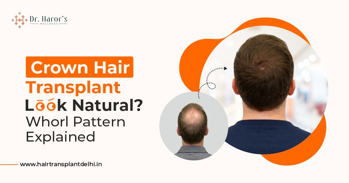 Does Crown Hair Transplant Look Natural? Understanding the Whorl Pattern